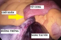 Đau bụng dữ dội, bé gái phải mổ gấp vì xoắn buồng trứng có thể gây vô sinh 