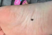 'Nốt ruồi' này trên cơ thể đứa trẻ có nghĩa là 'may mắn' 