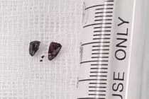 Mảnh pháo tự chế găm vào người một thanh niên đêm giao thừa