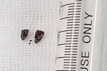 Mảnh pháo tự chế găm vào người một thanh niên đêm giao thừa