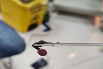 Kinh hoàng gắp con đỉa dài 3cm ký sinh trong hốc mũi người phụ nữ 