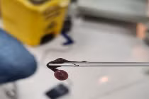 Kinh hoàng gắp con đỉa dài 3cm ký sinh trong hốc mũi người phụ nữ 