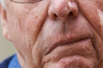 Ba dấu hiệu bị đột quỵ nhiều người thường bỏ qua