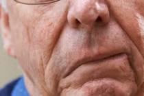 Ba dấu hiệu bị đột quỵ nhiều người thường bỏ qua