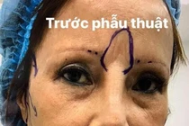 Mặt già nua gây sốc của cô dâu Cao Bằng sau 2 năm dao kéo 