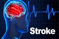 Dấu hiệu cảnh báo sớm cơn đột quỵ nhiều người bỏ qua