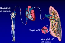 Thuyên tắc phổi suýt chết vì ôm máy tính hơn 12 giờ/ngày