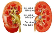 4 loại hoa quả "khắc tinh" của sỏi thận