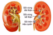 4 loại hoa quả "khắc tinh" của sỏi thận