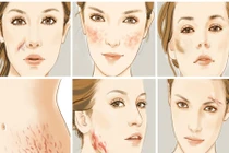 Sẹo phẫu thuật: Chăm sóc, điều trị đúng cách để không ân hận