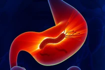 Đánh bay cơn đau dạ dày đơn giản, an toàn chỉ trong nháy mắt