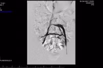 Lần đầu tiên đặt stent trị thành công suy tĩnh mạch chi dưới