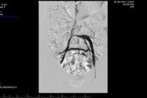 Lần đầu tiên đặt stent trị thành công suy tĩnh mạch chi dưới