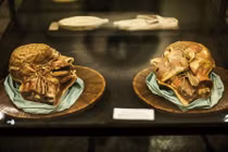 Tiết lộ về ca ghép đầu người được trông đợi năm 2017