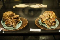 Tiết lộ về ca ghép đầu người được trông đợi năm 2017