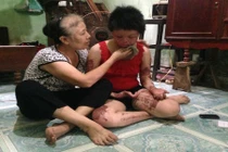 Nỗi đau tột cùng của người vợ trẻ bị chồng tẩm xăng thiêu sống