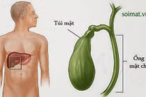 Triệu chứng âm thầm báo hiệu bệnh ung thư túi mật