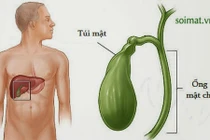 Triệu chứng âm thầm báo hiệu bệnh ung thư túi mật