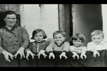 Xót xa với những dị tật kỳ dị, hiếm gặp trên thế giới