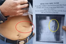 Xác nhận bác sĩ quên kéo trong bụng bệnh nhân 18 năm là có thật