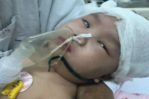 Ngã võng, bé gái 6 tháng tuổi bị chấn thương sọ não nguy kịch