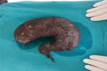 Phẫu thuật loại bỏ búi tóc trong dạ dày thiếu nữ 16 tuổi