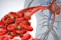 Mẹo đơn giản tự kiểm tra có chứng huyết khối nguy hiểm