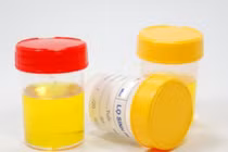 Nước tiểu có bọt: Dấu hiệu nguy hiểm của sức khỏe