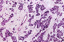 Tìm ra cách phát hiện sớm ung thư di căn từ vú sang phổi