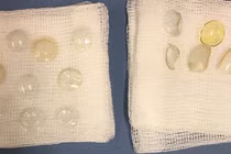 Bác sĩ hoảng hồn tìm thấy 27 miếng kính áp tròng trong mắt bệnh nhân