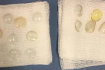 Bác sĩ hoảng hồn tìm thấy 27 miếng kính áp tròng trong mắt bệnh nhân