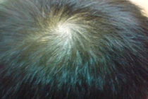 Đoán tính cách và vận mệnh đời người qua xoáy tóc