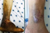 Căn bệnh nguy hiểm khiến bạn có thể phải cắt chân