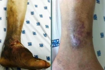 Căn bệnh nguy hiểm khiến bạn có thể phải cắt chân