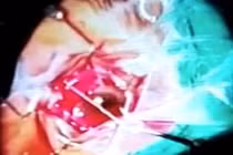 Kinh hoàng giun dài 7 cm làm tổ trong mắt