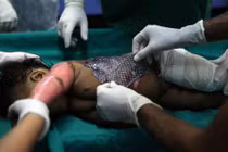 Độc đáo trị bỏng hiệu quả rẻ tiền bằng da cá rô phi