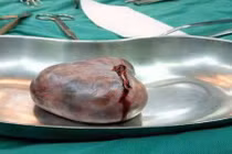 Cứu sống nữ sinh 18 tuổi mắc bệnh viêm não hiếm gặp 