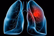 Đây chính là 10 bệnh ung thư đàn ông Việt mắc nhiều nhất