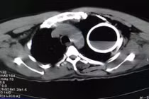 Hy hữu: Mổ cấp cứu lấy vỏ chai thủy tinh trong lồng ngực