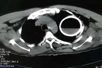 Hy hữu: Mổ cấp cứu lấy vỏ chai thủy tinh trong lồng ngực