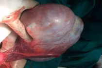 Khiếp đảm khối u nhầy buồng trứng khổng lồ nặng 1,8kg