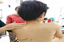 Bé trai bị bạn phóng kéo đứt động mạch chủ, mất gần 2 lít máu