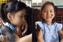 Bé gái 'người sói' sẽ được chữa bệnh miễn phí