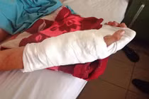 Bệnh viên ĐK Khánh Hòa nối thành công bàn tay đứt lìa