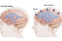 Cha mẹ quyết phẫu thuật cho con dù bác sĩ lắc đầu