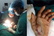 313 người nhập viện cấp cứu do tai nạn pháo nổ