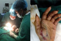 313 người nhập viện cấp cứu do tai nạn pháo nổ