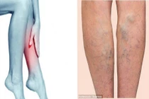 Nổi mạch máu ở chân có thể là triệu chứng của nhiều bệnh chết người