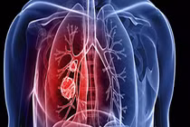 Video: 6 nhóm người chắc chắn mắc ung thư phổi 