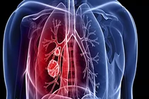 Video: 6 nhóm người chắc chắn mắc ung thư phổi 